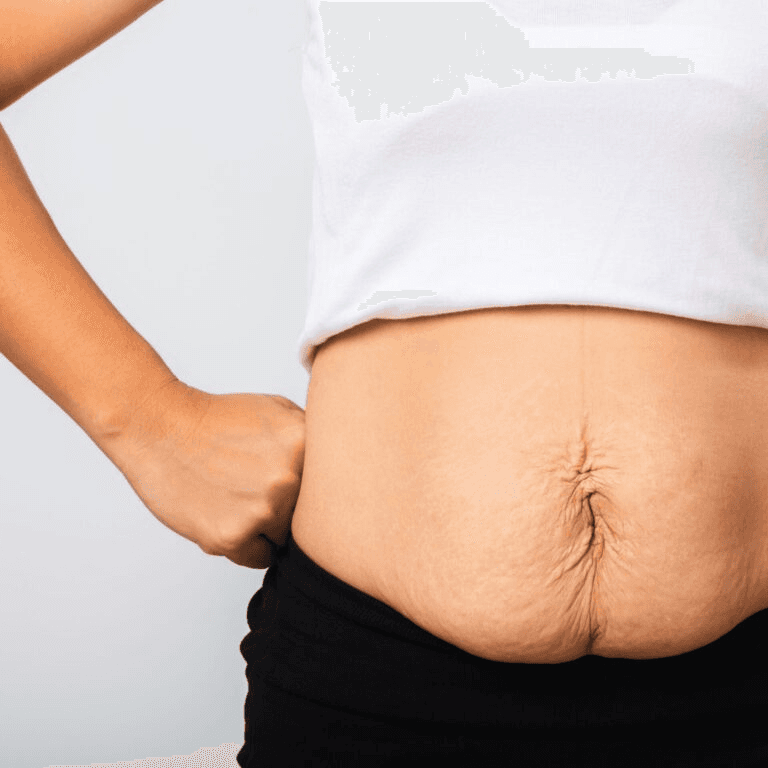 weight loss loose skin