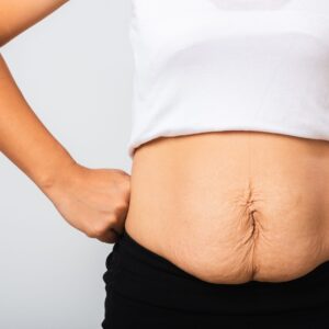 loose skin after rapid weight loss